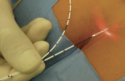 Dra. Marcella Conz Coloproctologia, Laser em coloproctologia
▫️Doenças Inflamatórias Intestinais São Bernardo do Campo